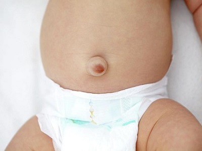 Hernia1