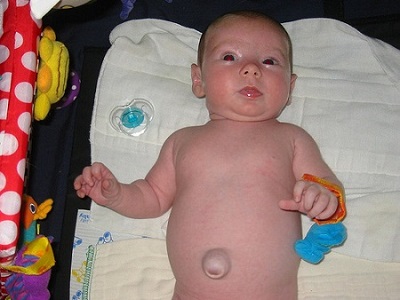 Hernia3
