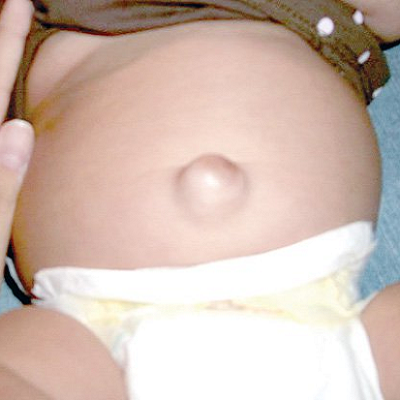 Hernia5