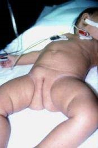 Hernia6