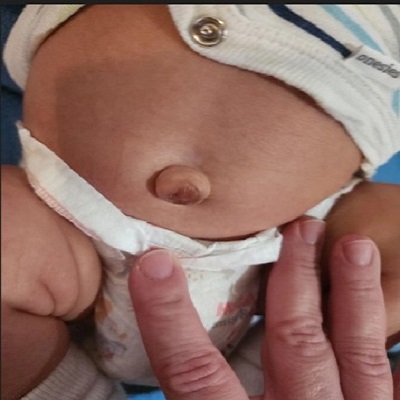 Hernia6