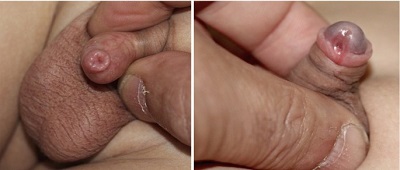 Phimosis1